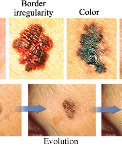 Melanoma is no joke! Protect your skin!